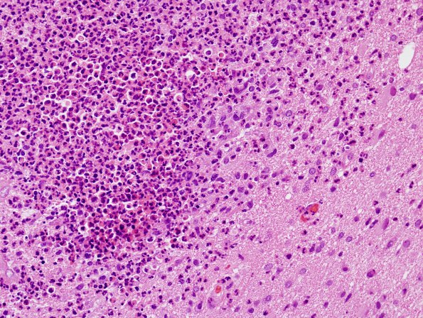 7B2 Tuberculous meningoencephalitis (Case 7) H&E 1