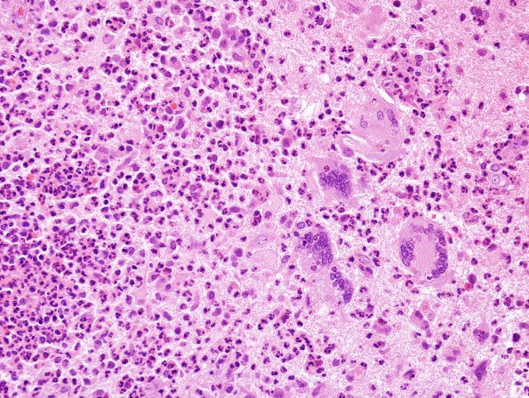 7B3 Tuberculous meningoencephalitis (Case 7) H&E 20