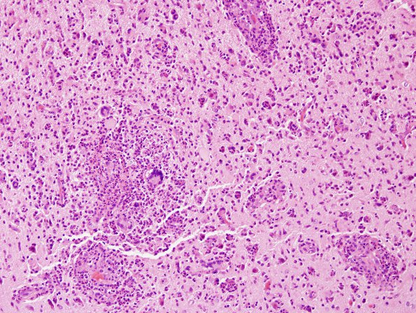 7B4 Tuberculous meningoencephalitis (Case 7) H&E 12