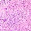 7B5 Tuberculous meningoencephalitis (Case 7) H&E 9