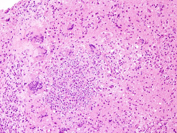 7B5 Tuberculous meningoencephalitis (Case 7) H&E 9