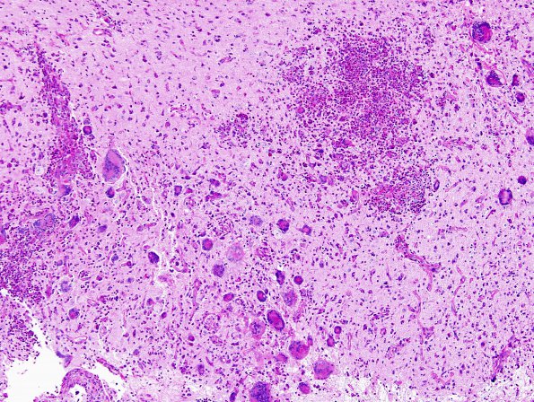 7C1 Tuberculous meningoencephalitis (Case 7) PAS 5