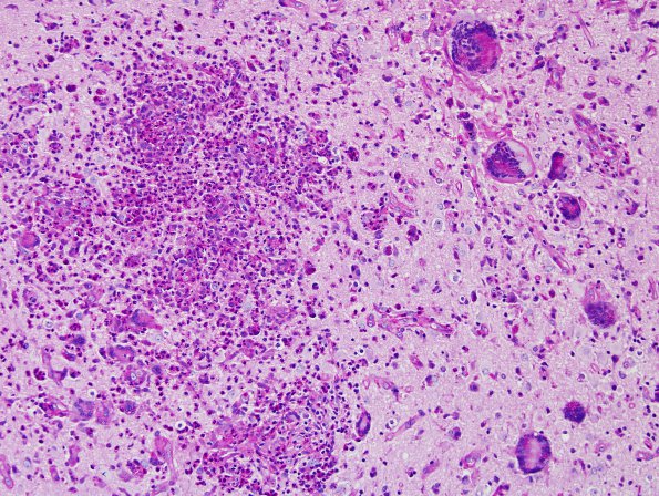 7C2 Tuberculous meningoencephalitis (Case 7) PAS 2