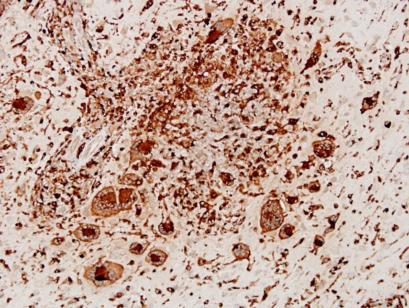 7C5 Tuberculous meningoencephalitis (Case 7) CD68 8