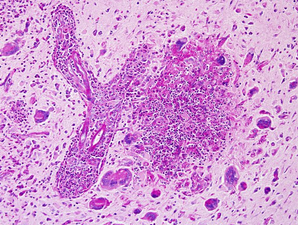 7D1 Tuberculous meningoencephalitis (Case 7) PAS 3