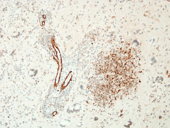 7D2 Tuberculous meningoencephalitis (Case 7) SMA 5