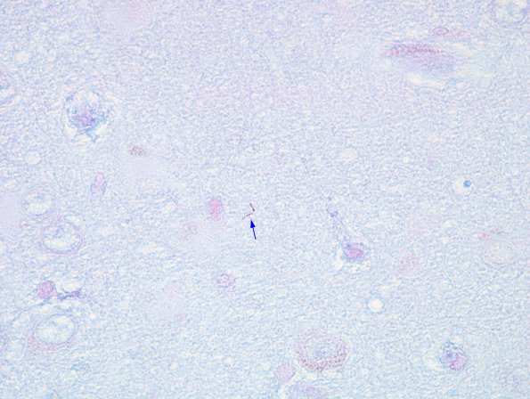 7D3 Tuberculous meningoencephalitis (Case 7) AFB 4 copy