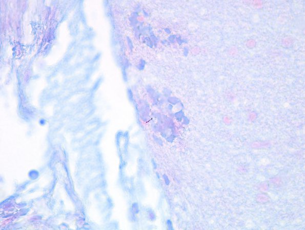 7D4 Tuberculous meningoencephalitis (Case 7) AFB 4 copy