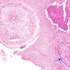 8A1 TB Meningitis (Case 8) 1 copy