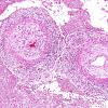 8A2 TB Meningitis (Case 8) arteritis 3