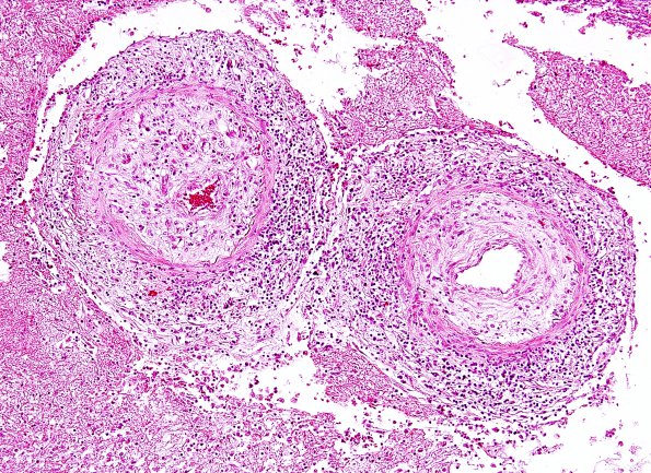 8A2 TB Meningitis (Case 8) arteritis 3