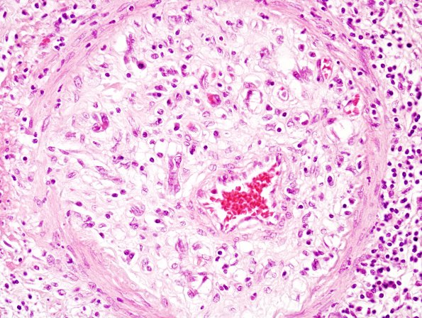 8A3 TB Meningitis (Case 8) arteritis 2