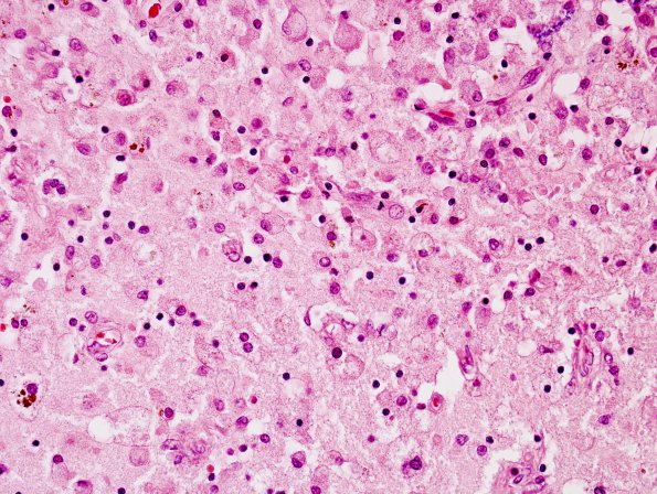 8A4 TB Meningitis (Case 8) arteritis 1