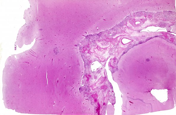 9A1 TB Meningitis (Case 9) H&E whole mount