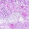 9A2 TB Meningitis (Case 9) H&E 4