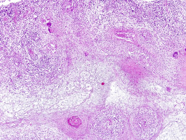 9A2 TB Meningitis (Case 9) H&E 4