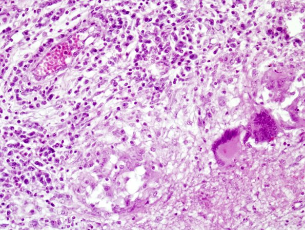 9A3 TB Meningitis (Case 9) H&E 1