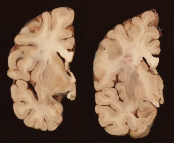 1A2 Whipple's Dz (Case 1) Gross_2