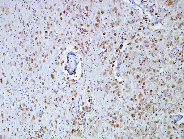 1E2 Whipple's Dz (Case 1) Anti-Tropheryma whippleii Ab 3