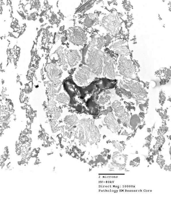 1F2 Whipple's Dz (Case 1) amygdala 016 - CopyA