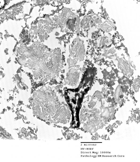 1F3 Whipple's Dz (Case 1) amygdala 032 - CopyA