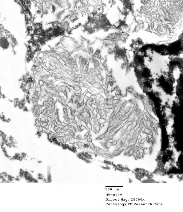 1F5 Whipple's Dz (Case 1) amygdala 033 - CopyAA