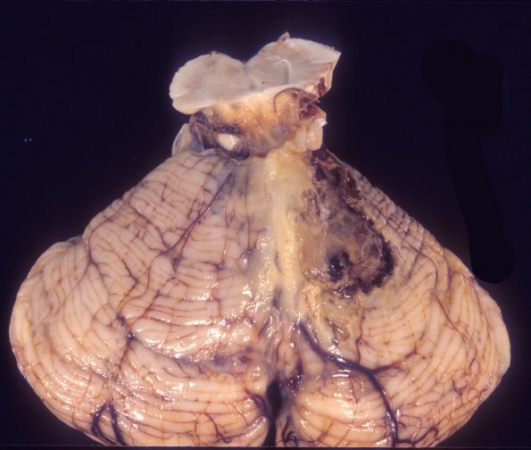 10A1 Aspergillus (Case 10) 3