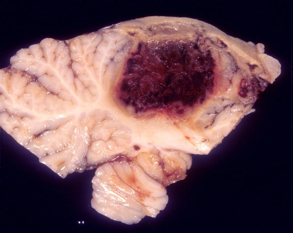 10A2 Aspergillus (Case 10) 1