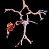 10A3 Aspergillus (Case 10) Right PICA 1