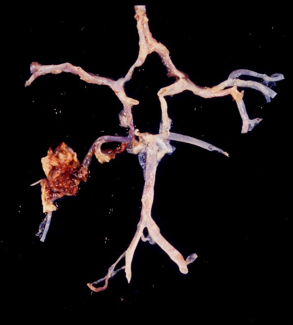 10A3 Aspergillus (Case 10) Right PICA 1