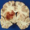 1 Aspergillosis - Gross Autopsy Neuropathology