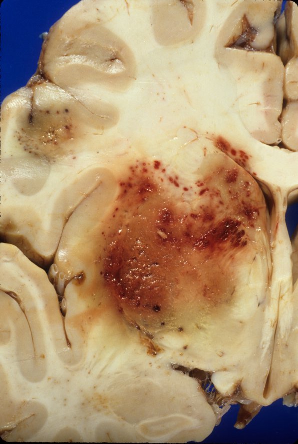 1a2 Aspergillosis (Case 1) 2A