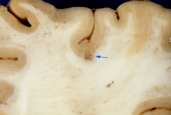 2A3 Aspergillosis (Case 2) 4 copy