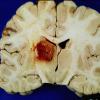 3A1 Aspergillosis (Case 3) infarct