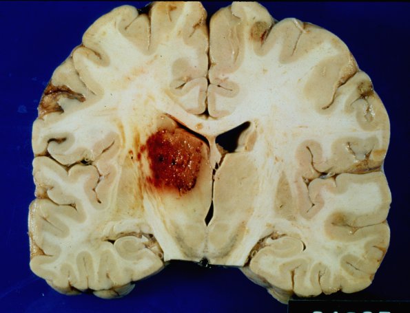 3A1 Aspergillosis (Case 3) infarct