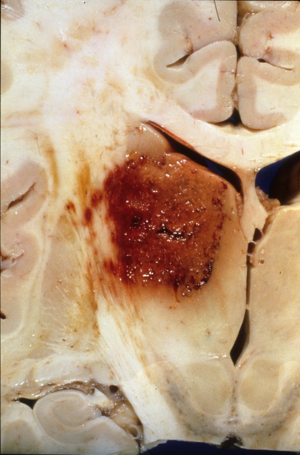 3A2 Aspergillosis (Case 3) basal ganglia