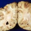 3A3 Aspergillosis (Case 3) infarct 2 copy