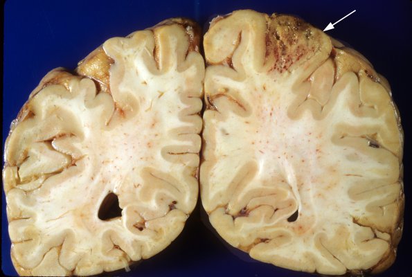 3A3 Aspergillosis (Case 3) infarct 2 copy