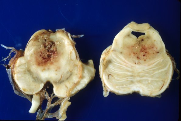 3A6 Aspergillosis (Case 3) infarct 3