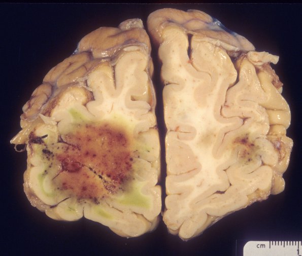 4A1 Aspergillosis (Case 4) 5A