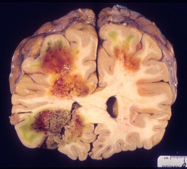 4A2 Aspergillosis (Case 4) 2AA