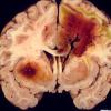 4A3 Aspergillosis (Case 4) 2