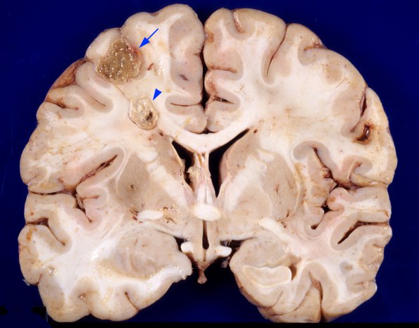 6A1 Aspergillosis, brain culture proven (Case 6) 8