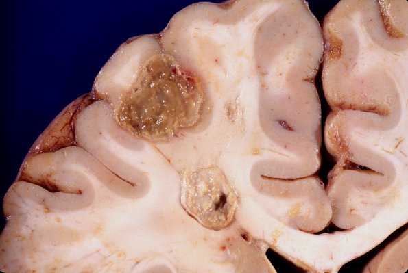 6A2 Aspergillosis, brain culture proven (Case 6) 5