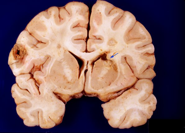 6A3 Aspergillosis, brain culture proven (Case 6) 2 copy