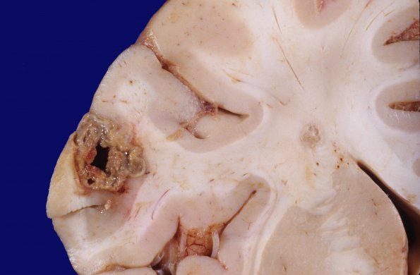 6A5 Aspergillosis, brain culture proven (Case 6) 3