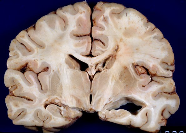 6A6 Aspergillosis, brain culture proven (Case 6) 7