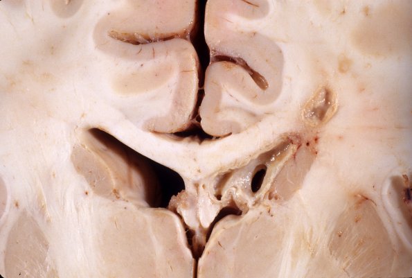 6A7 Aspergillosis, brain culture proven (Case 6) 4