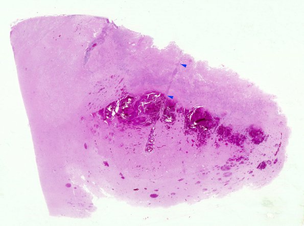 1A1 Aspergillus (Case 1) H&E whole mount copy A