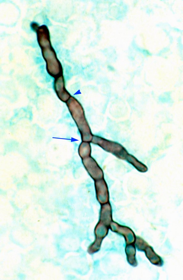 1A10 Aspergillosis 3 organism (Case 1) GMS copy